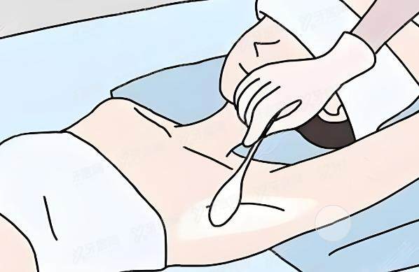 术除腋臭多少钱