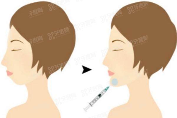 玻尿酸丰下巴是否有后遗症或风险？yimei.yadoo.cn
