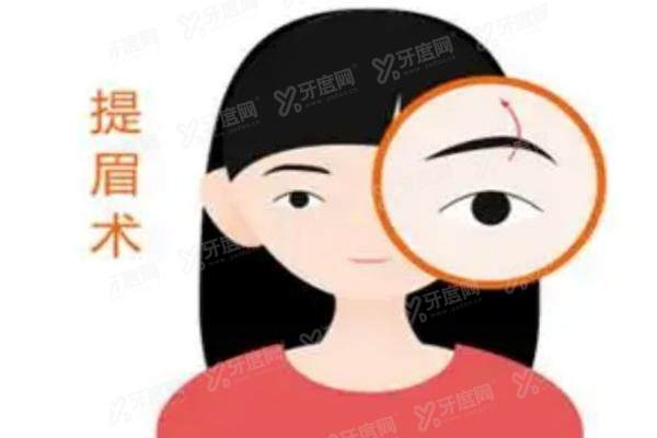 切提眉yimei.yadoo.cn.jpg