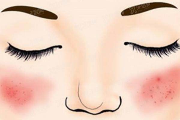 祛红血丝后注意事项yimei.yadoo.cn