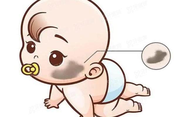 去胎记一般要多少钱yimei.yadoo.cn