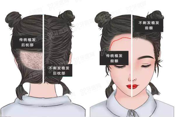 发际线植发yimei.yadoo.cn