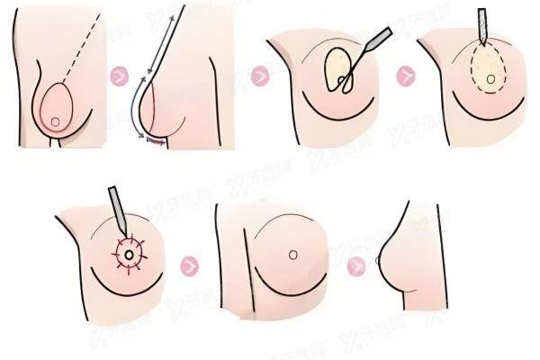 乳晕整形手术方法.jpg