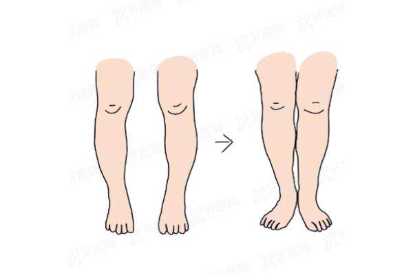 O型腿/OX型腿腿型矫正yimei.yadoo.cn