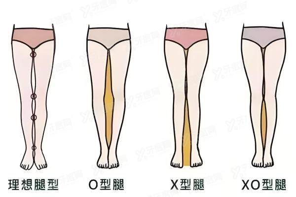 O型腿/OX型腿腿型矫正yimei.yadoo.cn