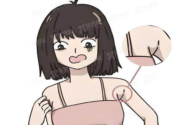 去副乳手术后需要注意什么？yimei.yadoo.cn.jpg