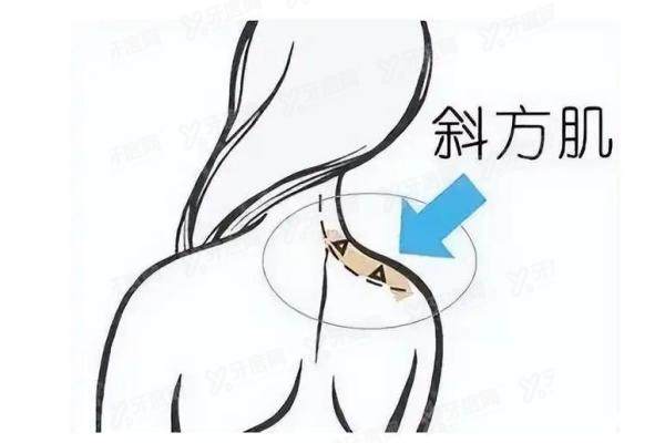 注射瘦 肩针yimei.yadoo.cn.jpg