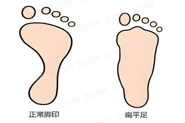 扁平足矫正yimei.yadoo.cn