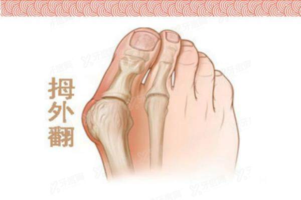 大脚骨矫正yimei.yadoo.cn