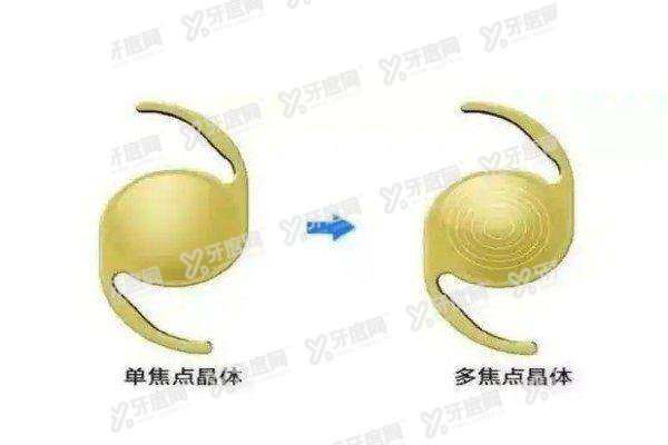 区域折射多焦人工晶状体价格2.jpg