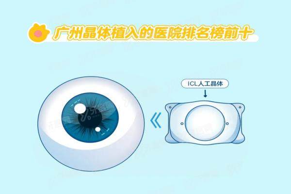 广州做晶体植入的医院排名榜前十：爱尔|佰视佳|常春藤|华厦等好医院上榜前十