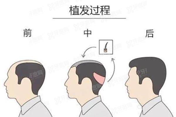碧莲盛植发医院正规吗