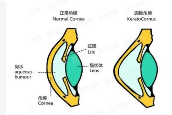北京做圆锥角膜好的医院.jpg
