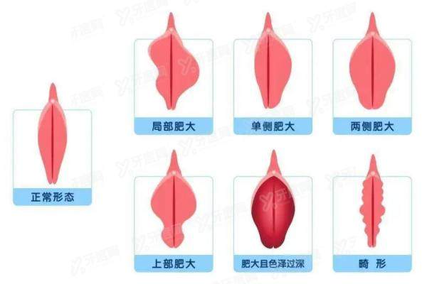 馒头型和蝴蝶型哪个好