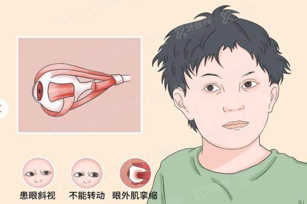 王乐今做斜视手术怎么样？微创不拆线,成人90%儿童85%成功率,费用5千起！