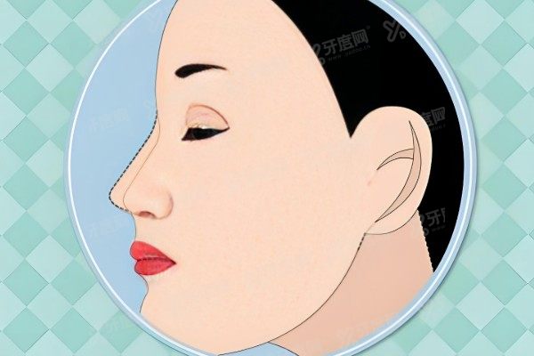 隆鼻后鼻子里面臭臭的是不是有棉花