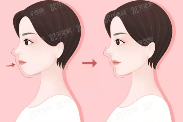 重庆松山医院正颌手术费用