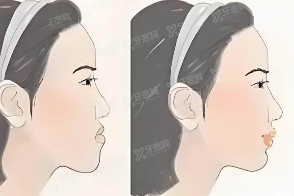 正颌手术是什么