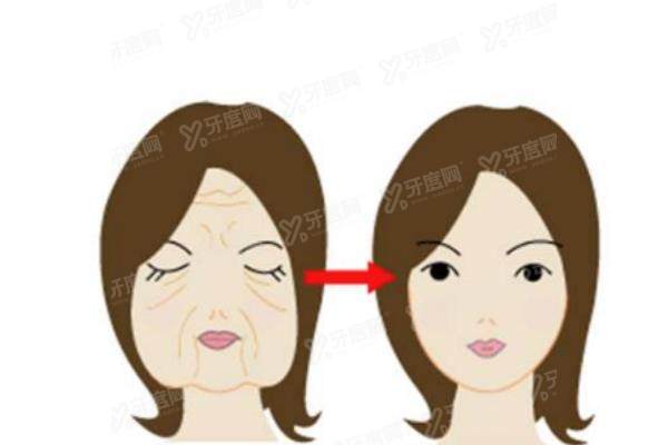 大拉皮手术和小拉皮手术的区别是什么