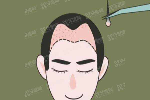 深圳植发医院哪个比较好