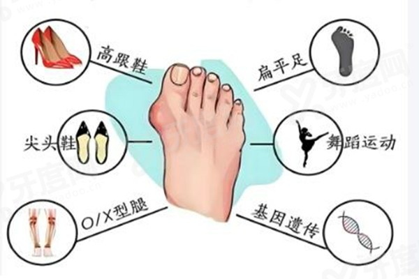 上海拇指外翻手术医院排名前三<span style=