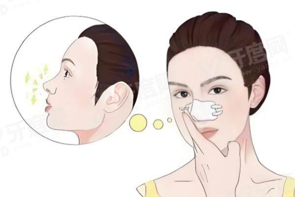 杭州李保锴修复鼻子怎么样