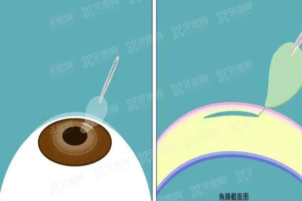 程正福医生做飞秒手术价格