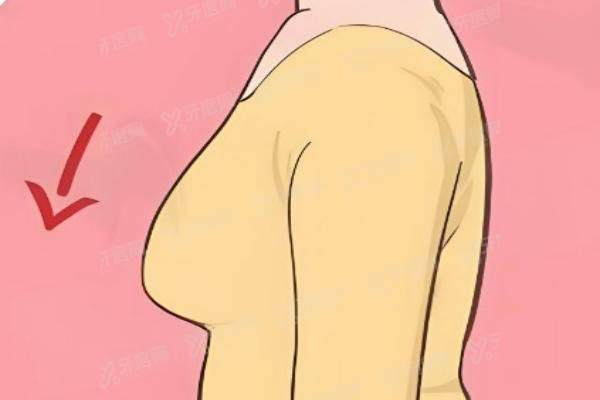 高超医生做隆胸实例
