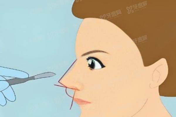 德州宋海涛医生做假体隆鼻实例
