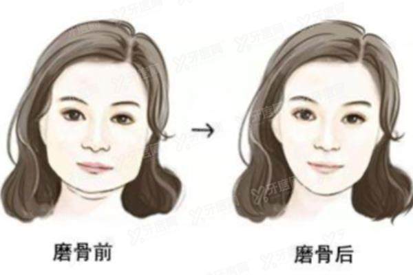 杭州磨骨哪个医生好