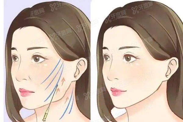 李建钢筋膜提升真的有用吗