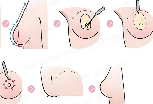 太原华晋医院做巨乳缩小手术口碑怎么样