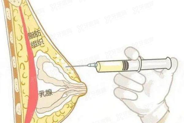 胸部奥美定取出费用多少钱？2万元起，附手术流程+附全国十佳医院