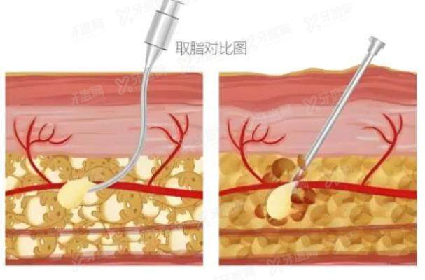 南宁芭芘丽整形医院抽脂医生