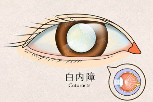 北京茗视光眼科医院医生名单分享:周跃华/朱思泉等医生近视技术好.jpg