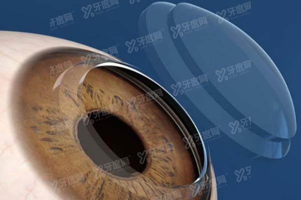 常州爱尔眼科医院全飞秒手术怎么样