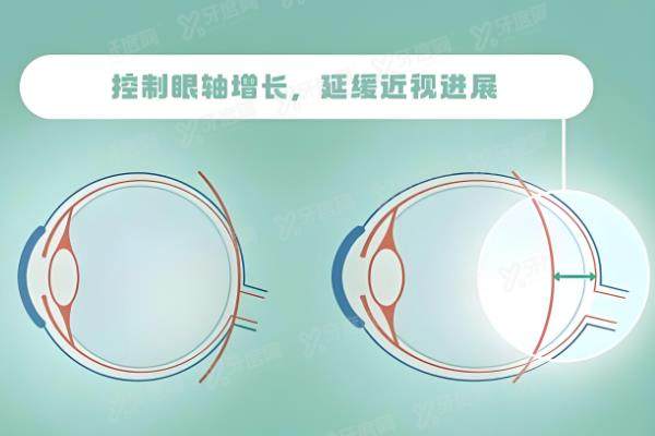 爱尔眼科医院全飞秒激光手术费用18000元起+晶体植入及飞秒手术价格一览表.jpg