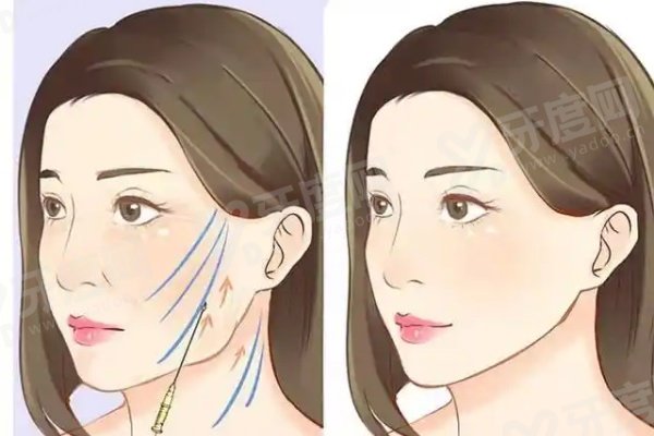 面部提升三件套多少钱？价格4万起！分层抗衰维持久，预约上海张路医生亲诊