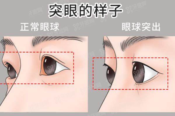 韩国必当归整形突眼矫正前后对比