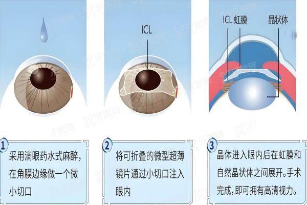 iclv5晶体植入多少钱？3-4万起，全新价格详情与就诊指南来啦！2