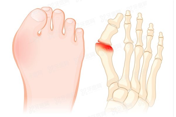 李昕宇拇外翻手术后修复注意事项