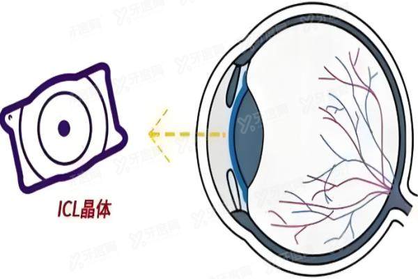 跃无极变焦人工晶体植入好不好?好,分享术后感受:优点远中近清晰/缺点价格高