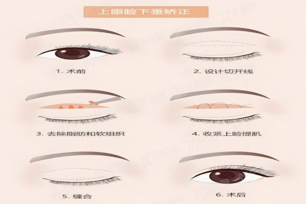 上睑下垂手术能报销吗?来看报销条件+高性价比医院推荐,价格5000元起!