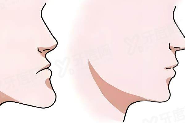 重庆正颌手术费用一般是多少钱