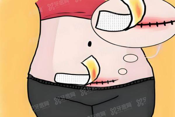 腹壁成形术亲身经历