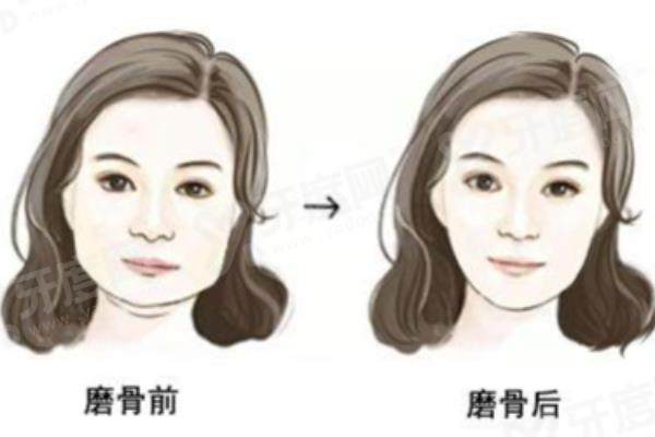 杭州高俊明磨骨多少钱？下颌角磨骨3w+颧骨颧弓3.5w+磨骨三件套6w起