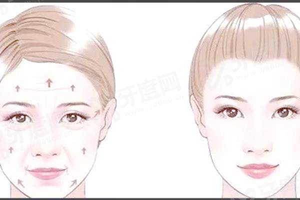 张路医生面部提升三件套怎么样