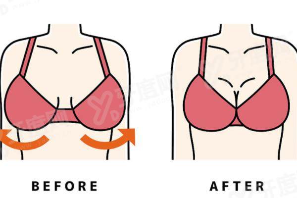 缩胸后束身衣穿多久