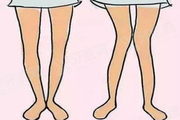 x 腿型矫正手术多少钱 x 腿型矫正手术多少钱