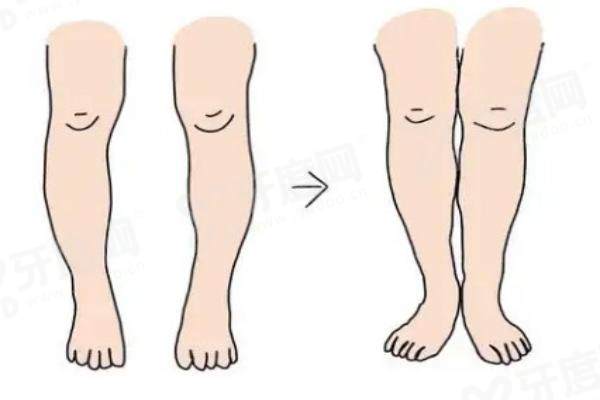 x腿型矫正机构推荐 x腿型矫正机构推荐